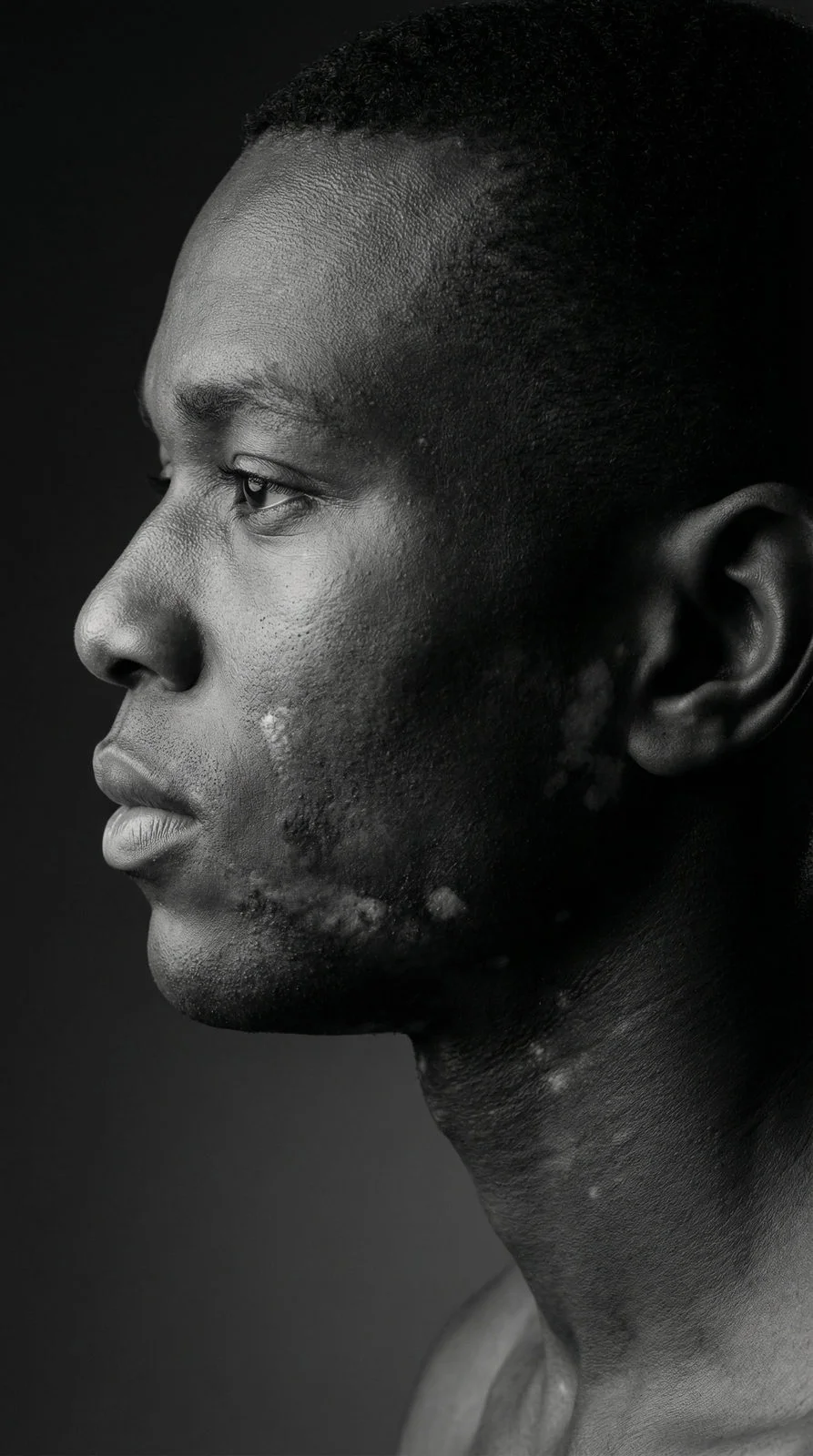 Vitiligo Portrait